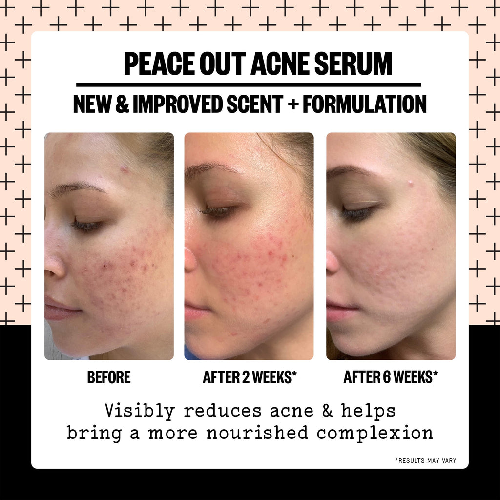 Salicylic Acid Acne Treatment Serum | Peace Out Skincare