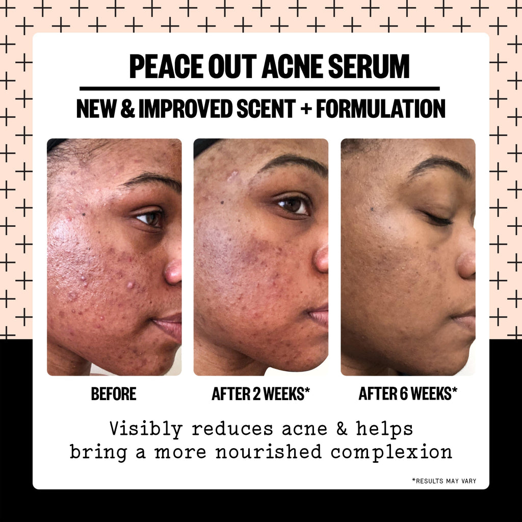 Salicylic Acid Acne Treatment Serum | Peace Out Skincare