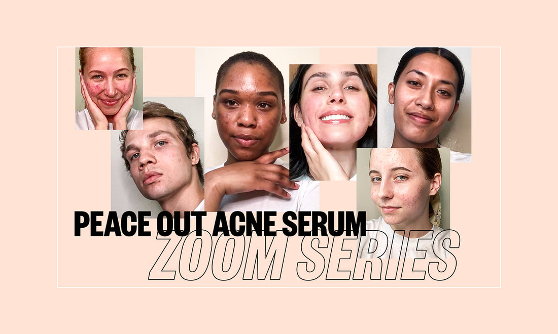 inspiring acne stories