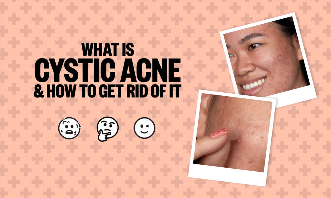 What is Cystic Acne & How To Get Rid of It