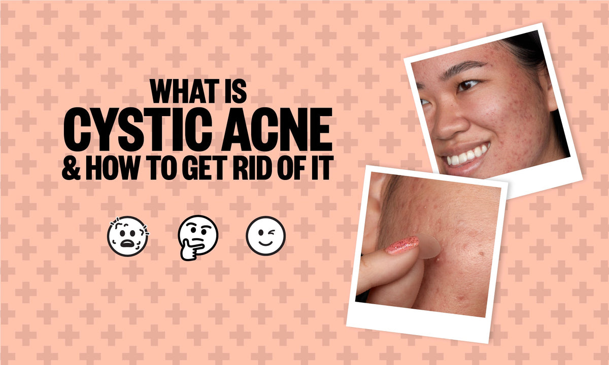What is Cystic Acne & How To Get Rid of It – Peace Out Skincare