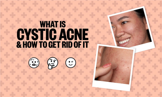 What is Cystic Acne & How To Get Rid of It