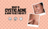What is Cystic Acne & How To Get Rid of It