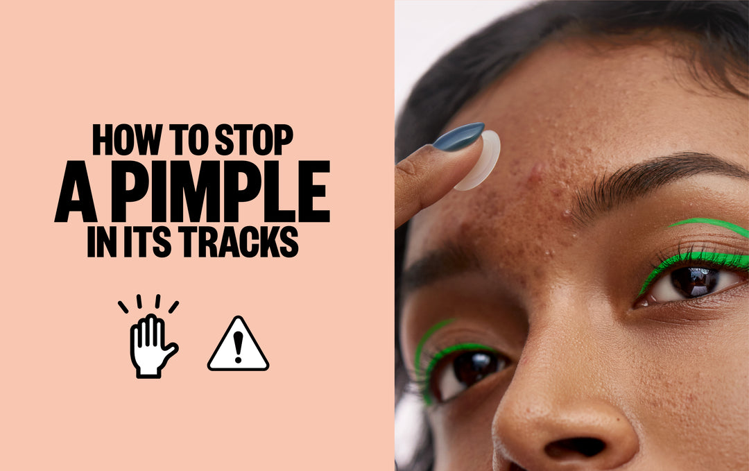 How to Stop a Pimple In Its Tracks Peace Out Skincare