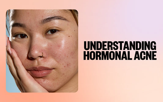 Understanding Hormonal Acne and How to Treat It