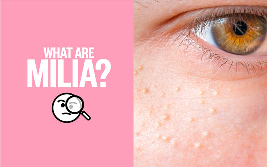 What Are Milia? Blog Post Title Image