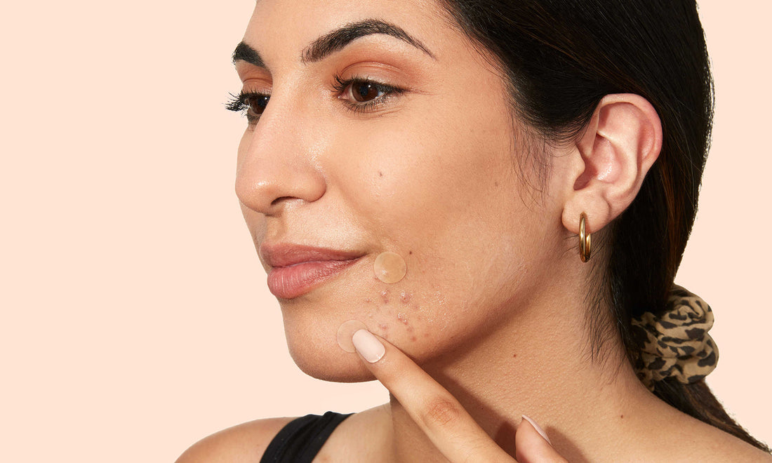 WHAT CAUSES ACNE & HOW TO PREVENT IT