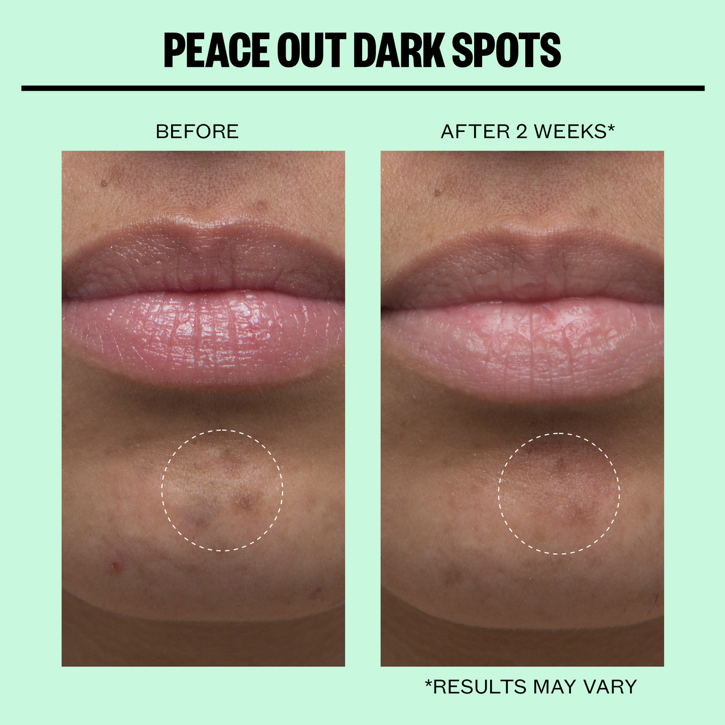 Dark Spots Microneedling Dots (CAN)