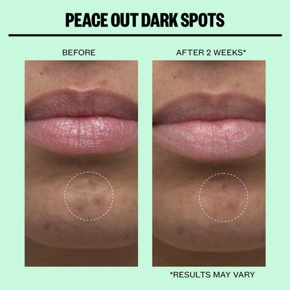 Dark Spots Microneedling Dots (CAN)