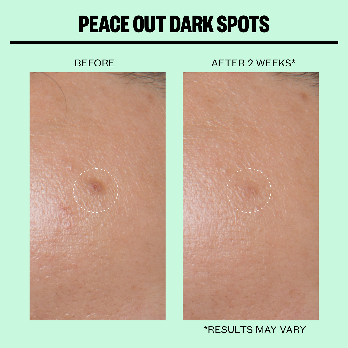 Dark Spots Microneedling Dots (CAN)