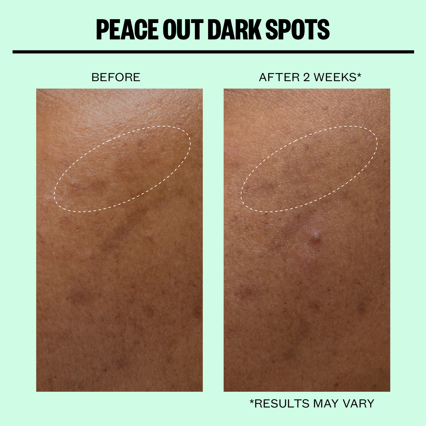 Dark Spots Microneedling Dots (CAN)