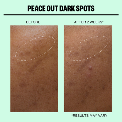 Dark Spots Microneedling Dots (CAN)