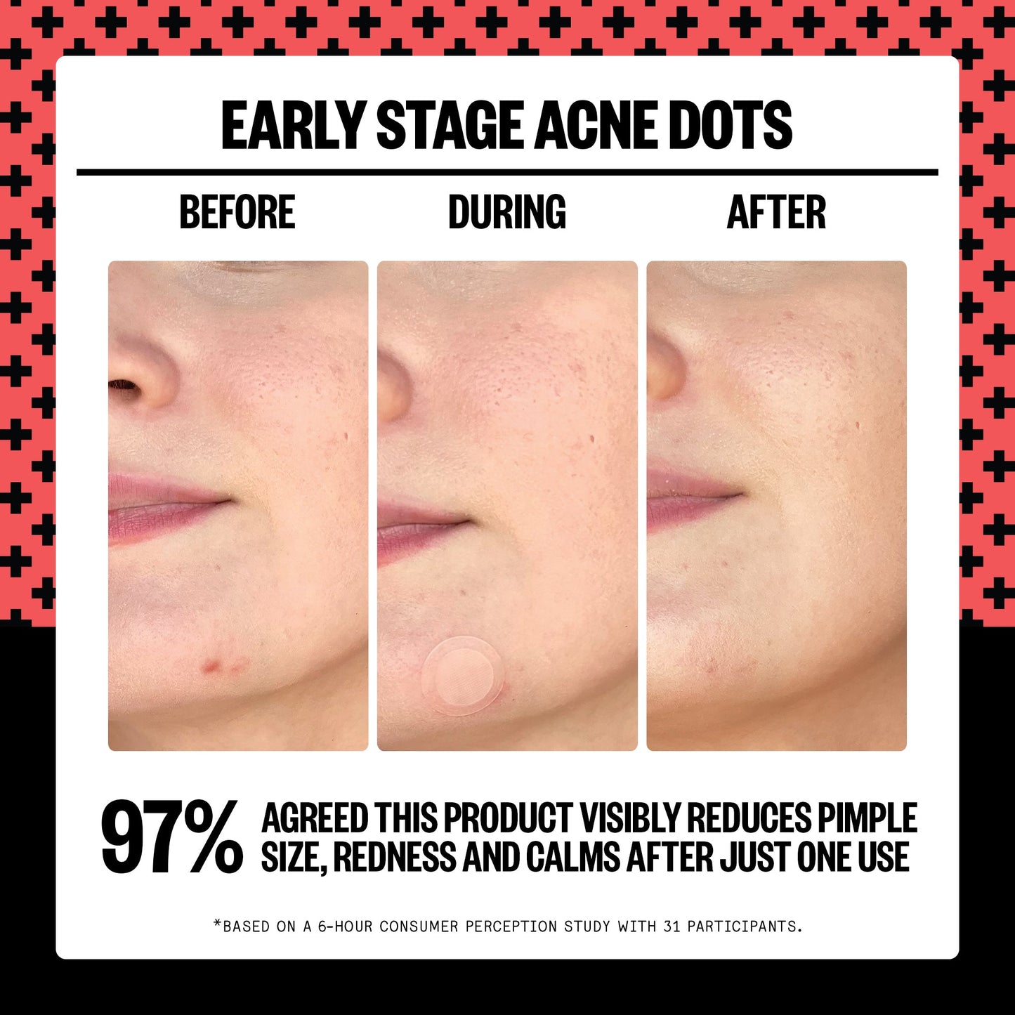 Early Stage Acne Dots (CAN)