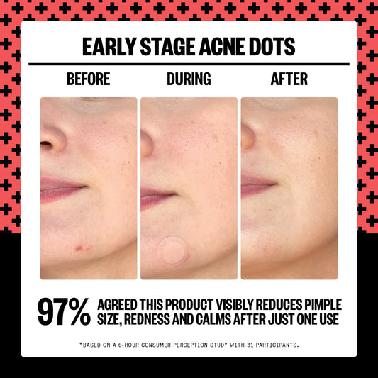 Early Stage Acne Dots (CAN)