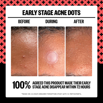 Early Stage Acne Dots