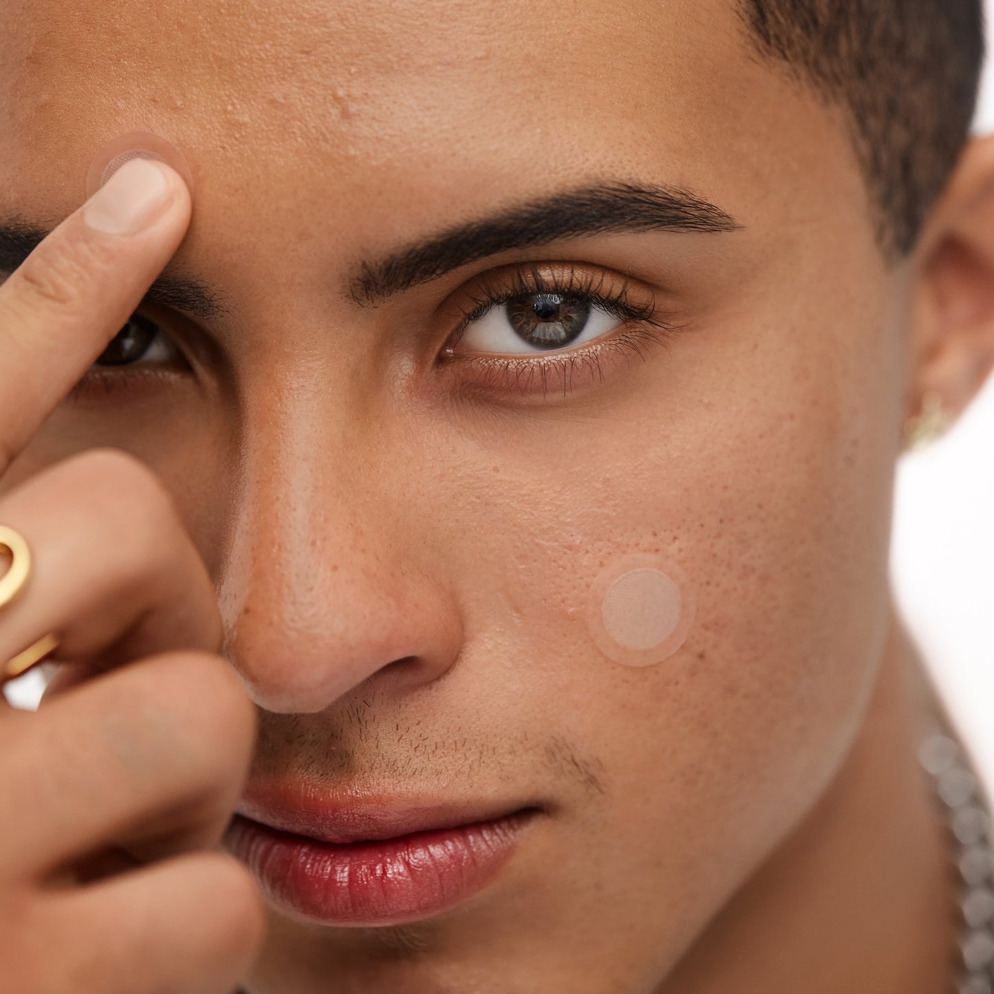 Early Stage Acne Dots (CAN)