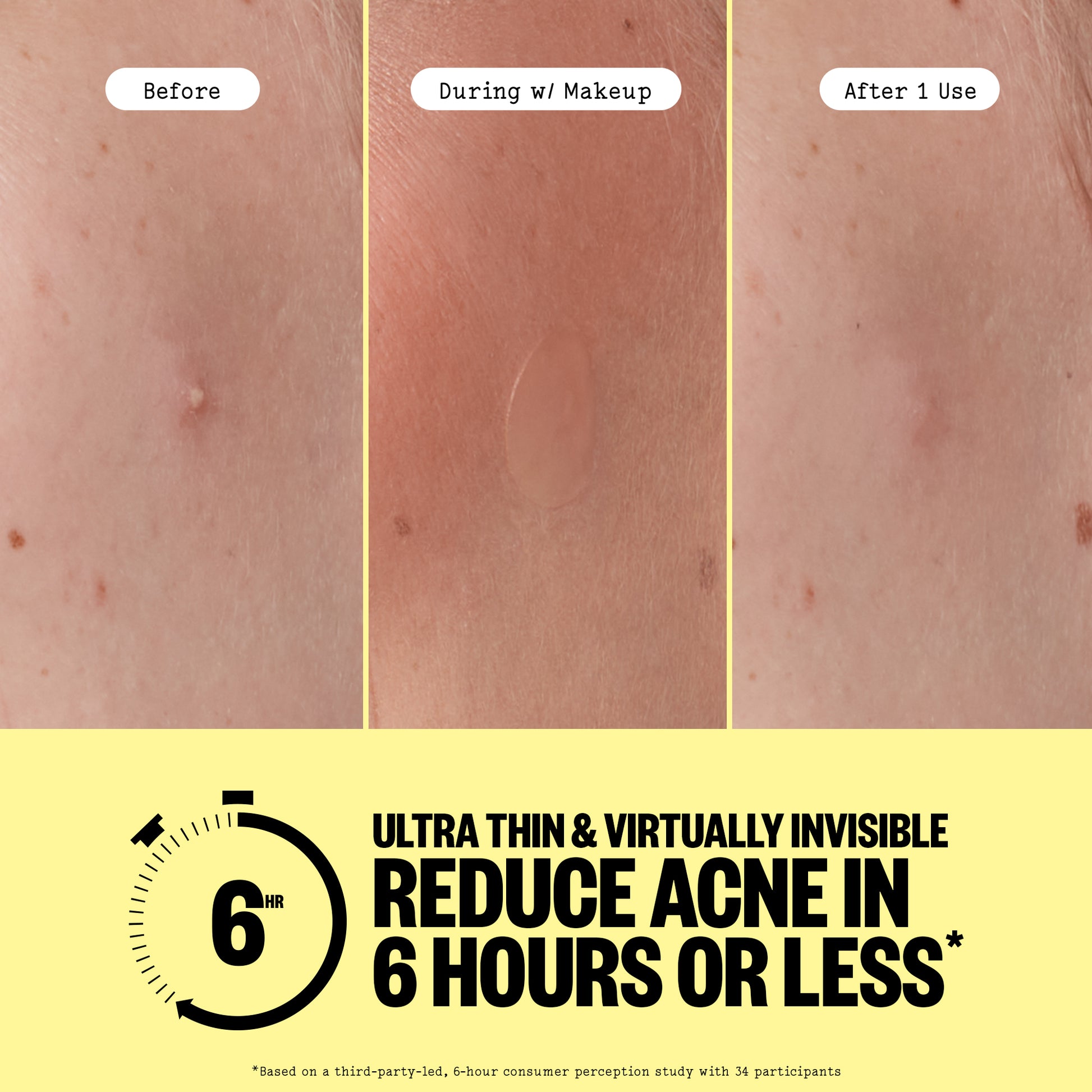 Acne Day Dot before, during with makeup, and after 1 use of a skincare product on skin with acne, with text highlighting quick results.