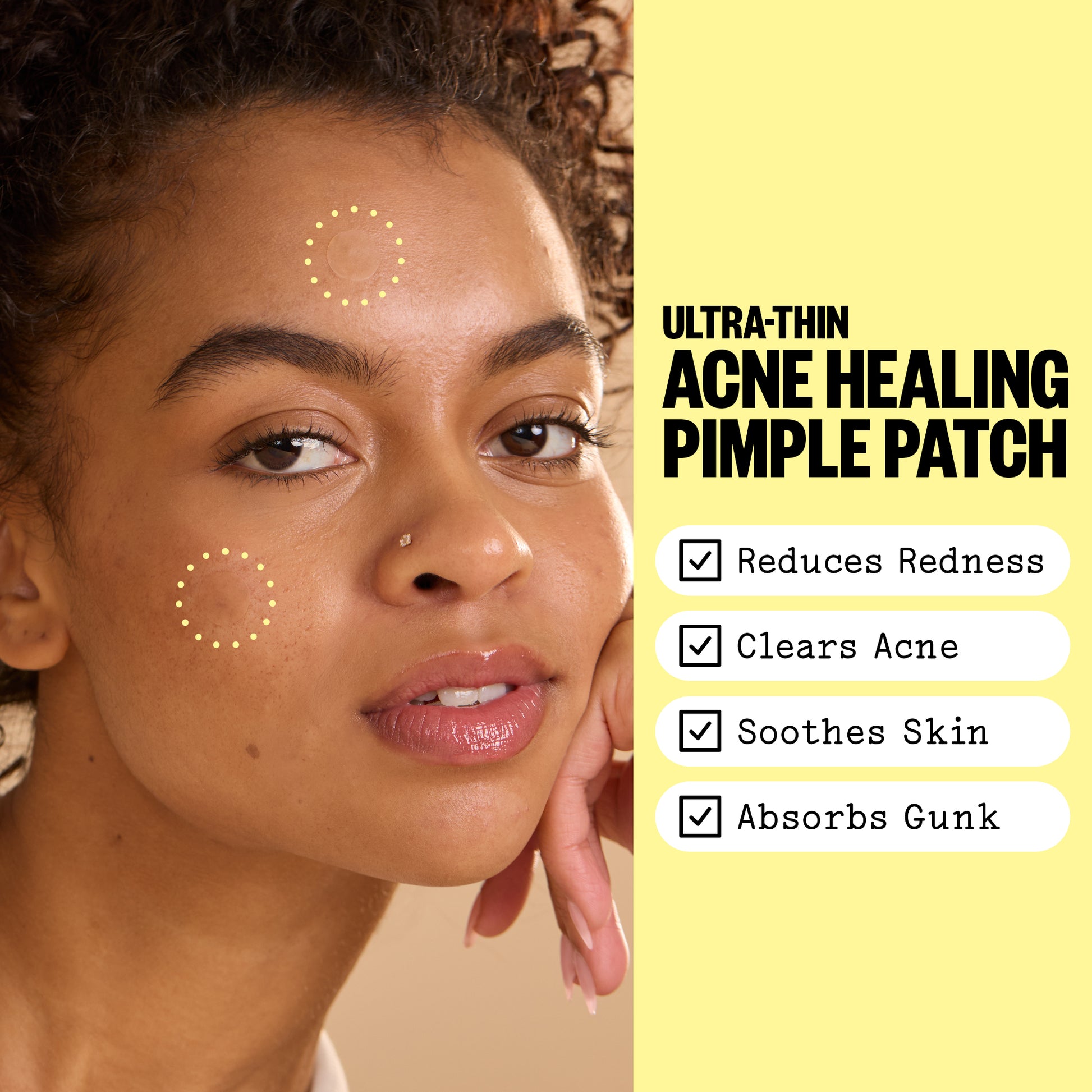 Woman with acne on her face and promotional text for ultra-thin acne healing pimple patches called Acne Day Dots