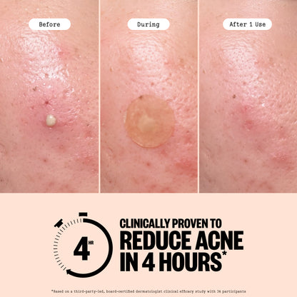 Before, during and after photos of a breakout clearing with a Peace Out acne patch.