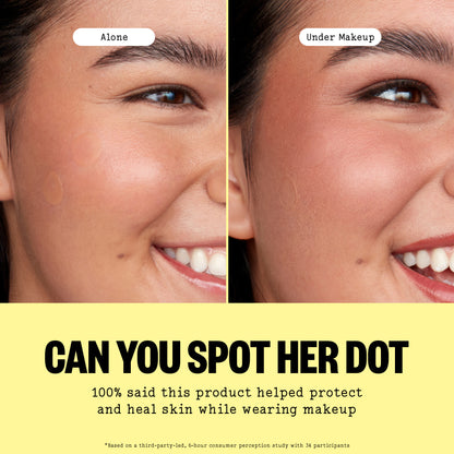 Before-and-after of a blemish concealed under makeup with a Peace Out Day Patch, then healed.