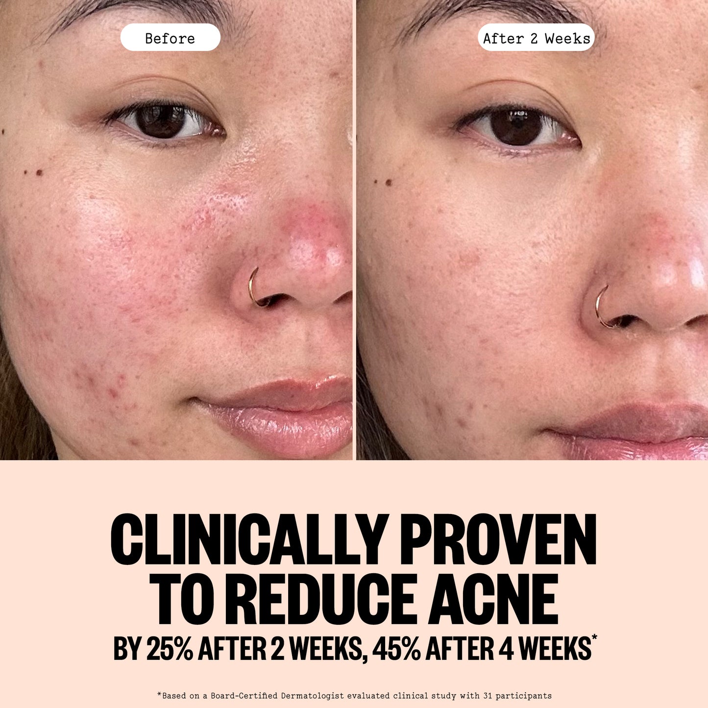 Before and After images of Acne Gel Cleanser with a clinical claim