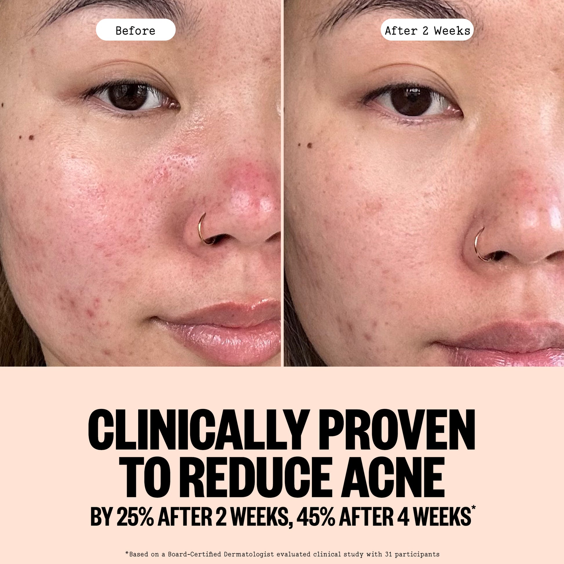 Before and After images of Acne Gel Cleanser with a clinical claim