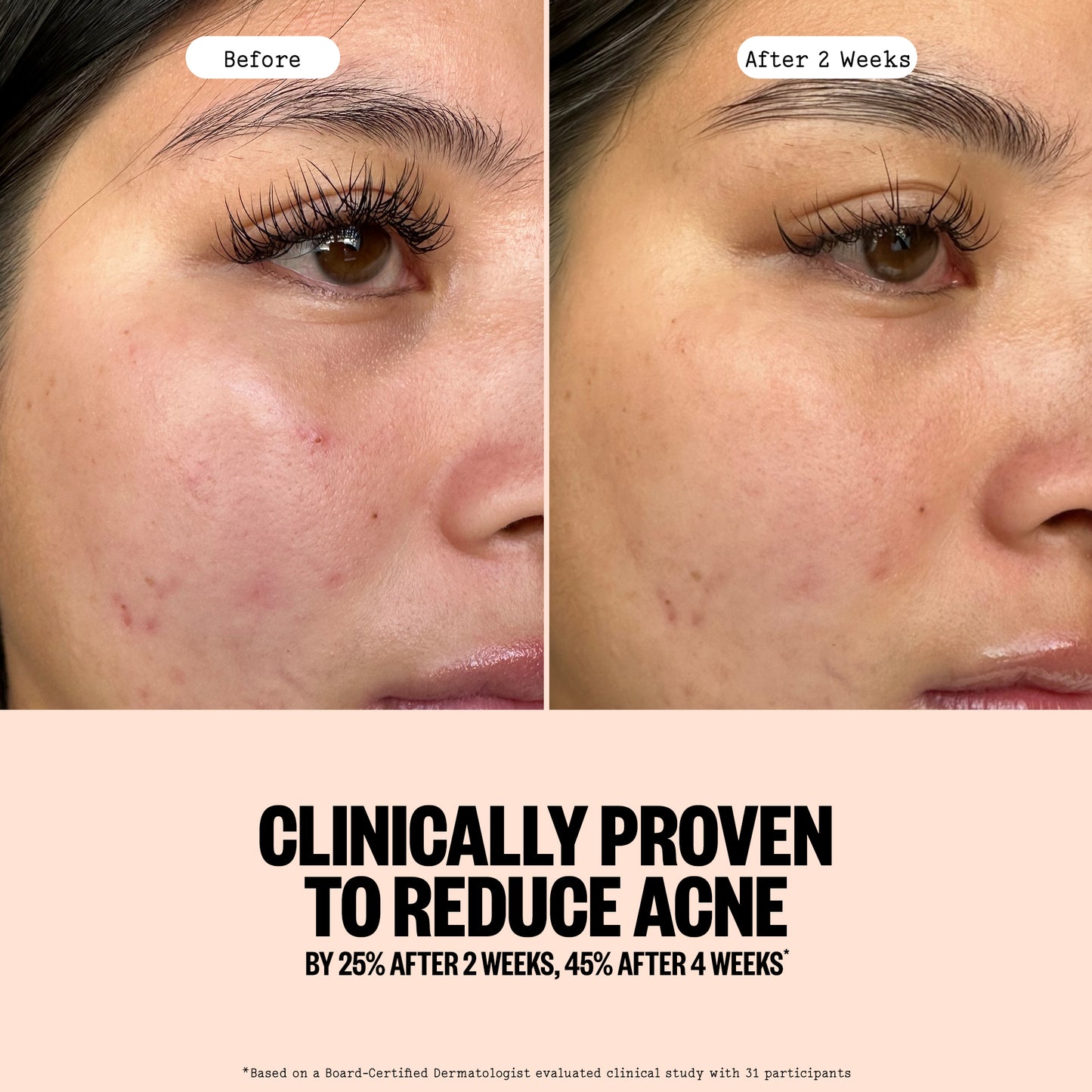 Acne Gel Cleanser