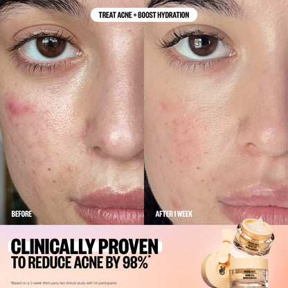 Woman holding Peace Out Acne Gel Moisturizer beside on-image salicylic acid benefits.
