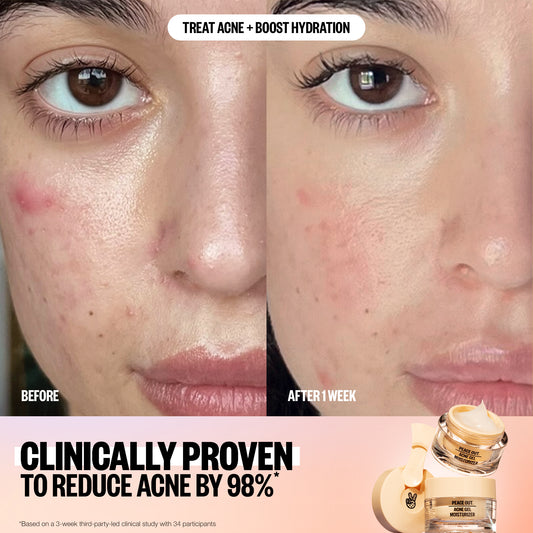 Acne Gel Moisturizer