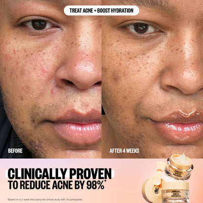 Peace Out Acne Gel Moisturizer packaging: 97% saw visibly clearer, smoother skin after 3 weeks.