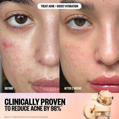 Peace Out Acne Gel Moisturizer with ingredients: salicylic acid, niacinamide, ceramides and hibiscus.