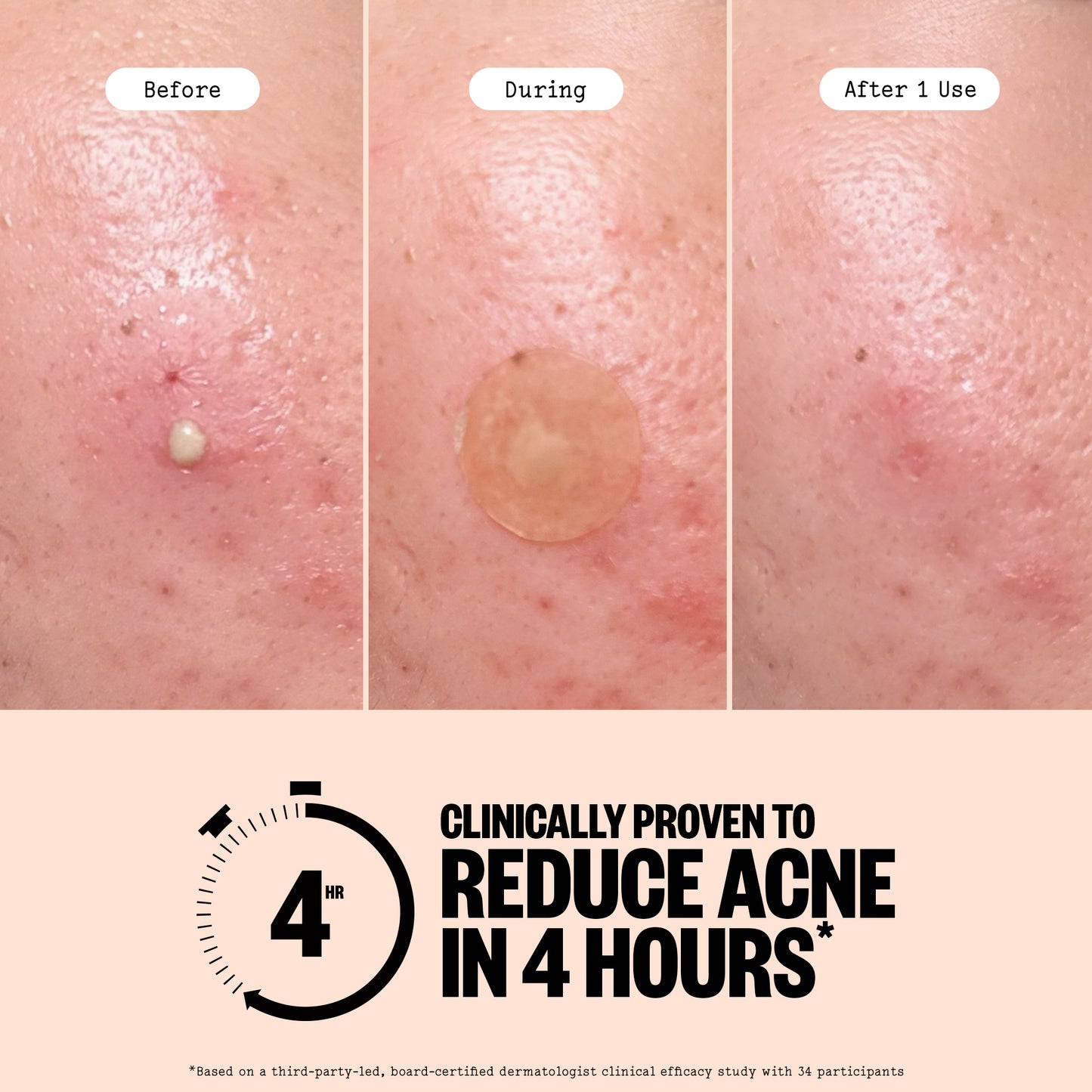 Before During and After using Acne Treatment Dot images with a caption: Clinically proven to reduce Acne in 4 Hours with a disclaimer.