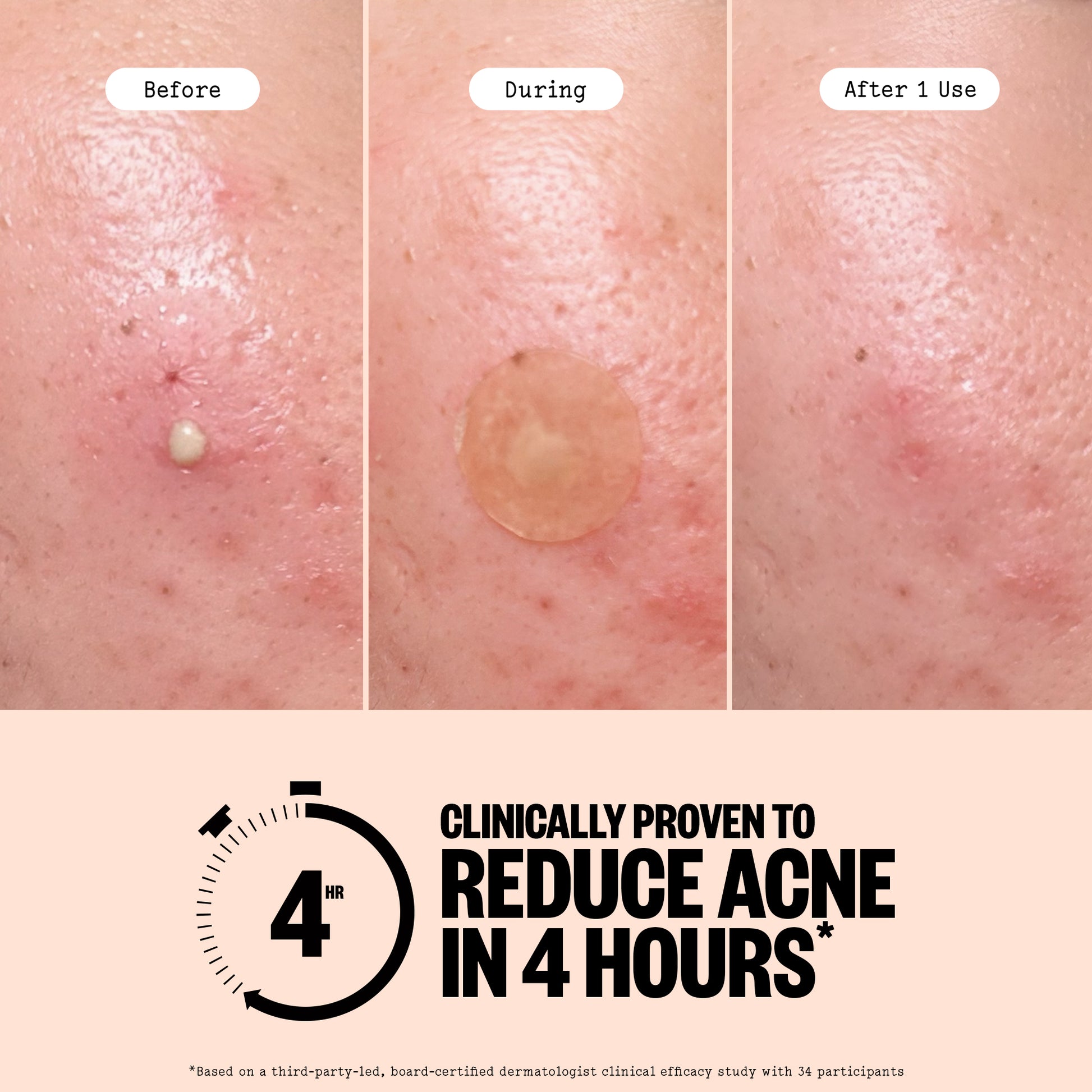 Before During and After using Acne Treatment Dot images with a caption: Clinically proven to reduce Acne in 4 Hours with a disclaimer.