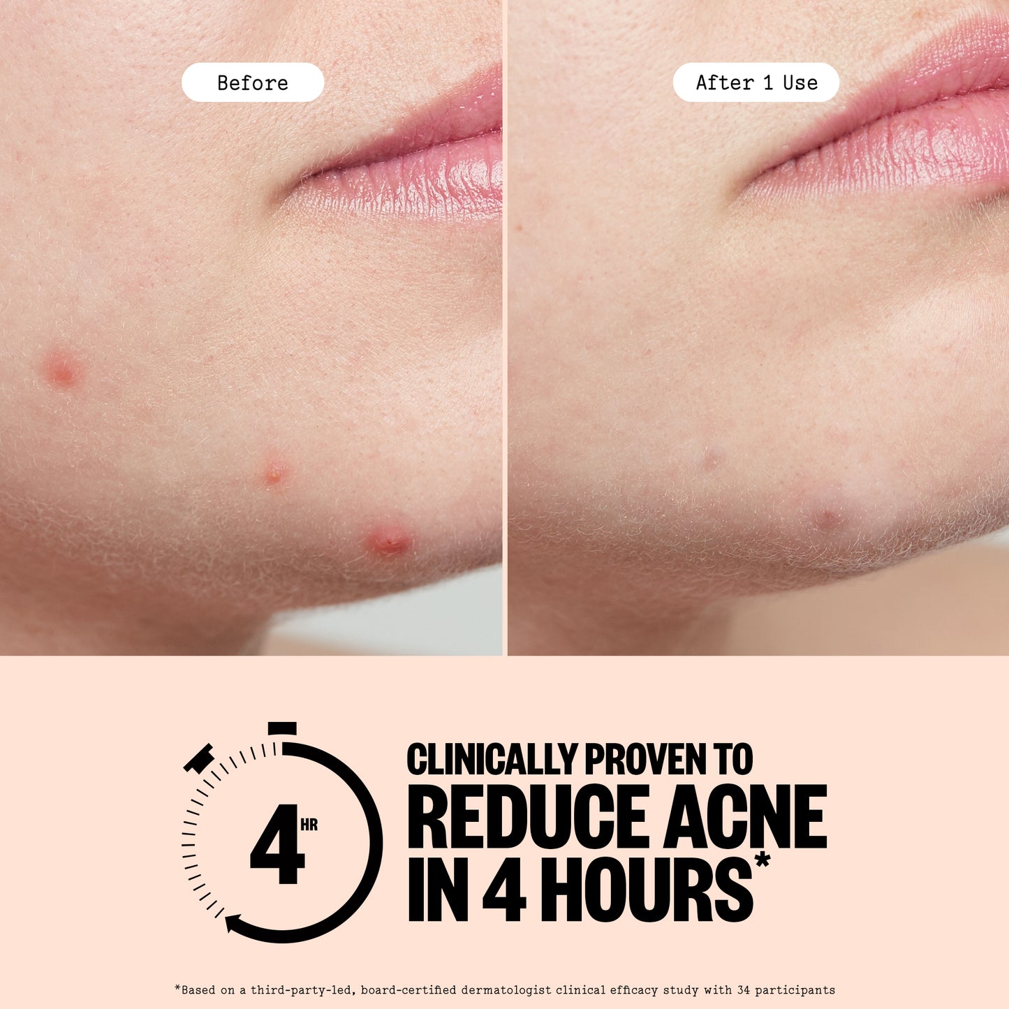Before and after comparison of acne on a person's face with text claiming clinical effectiveness.