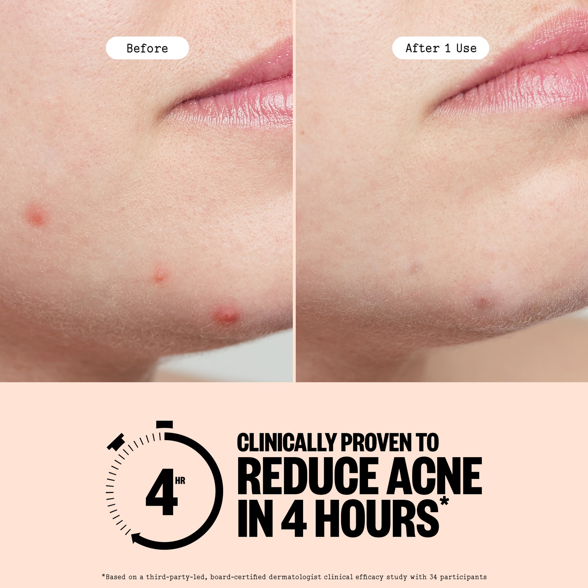 Before and after comparison of acne on a person's face with text claiming clinical effectiveness.