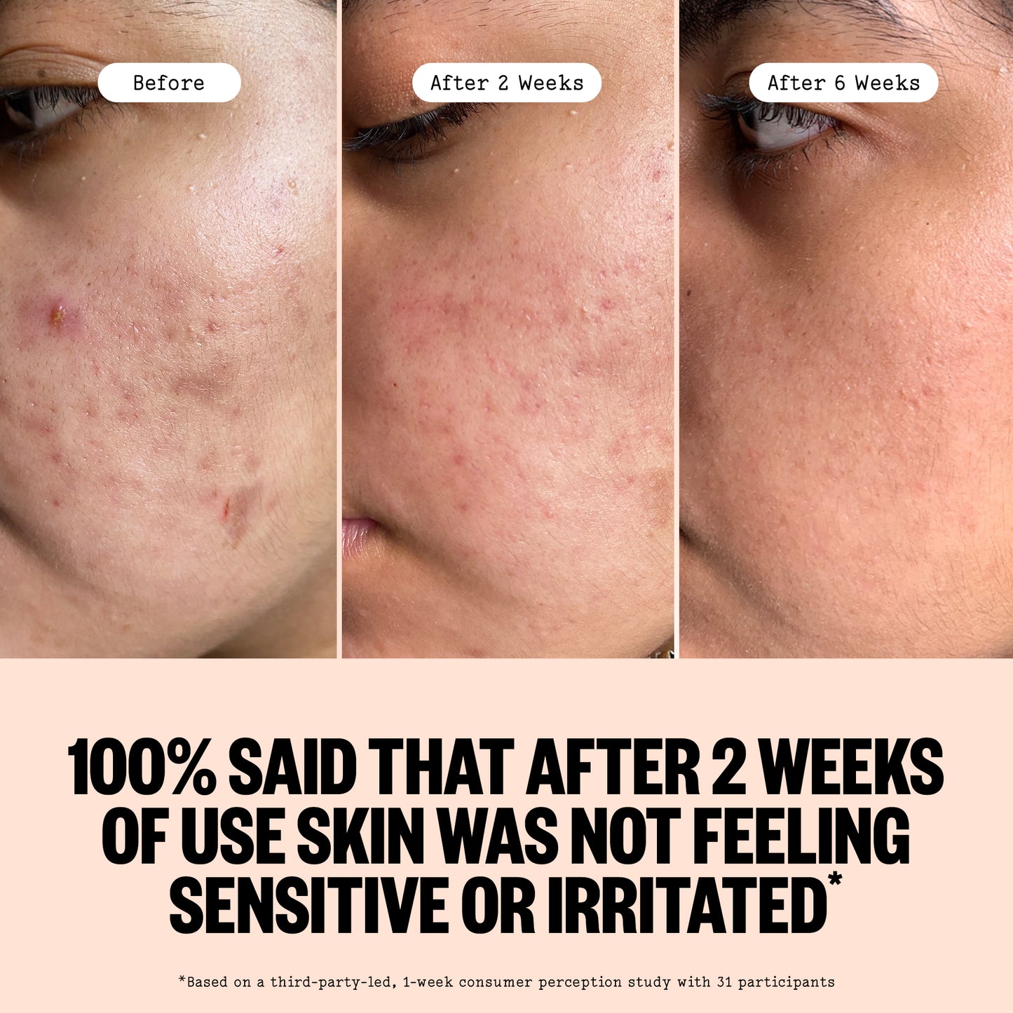 Before and after comparison of skin treatment through Peace Out Acne Serum on a person's face with text indicating improvement over 2 weeks.