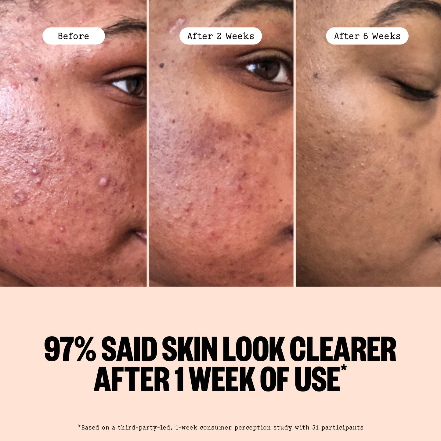 Before and after comparison of skin treatment through Peace Out Acne Serum showing improvement over time.
