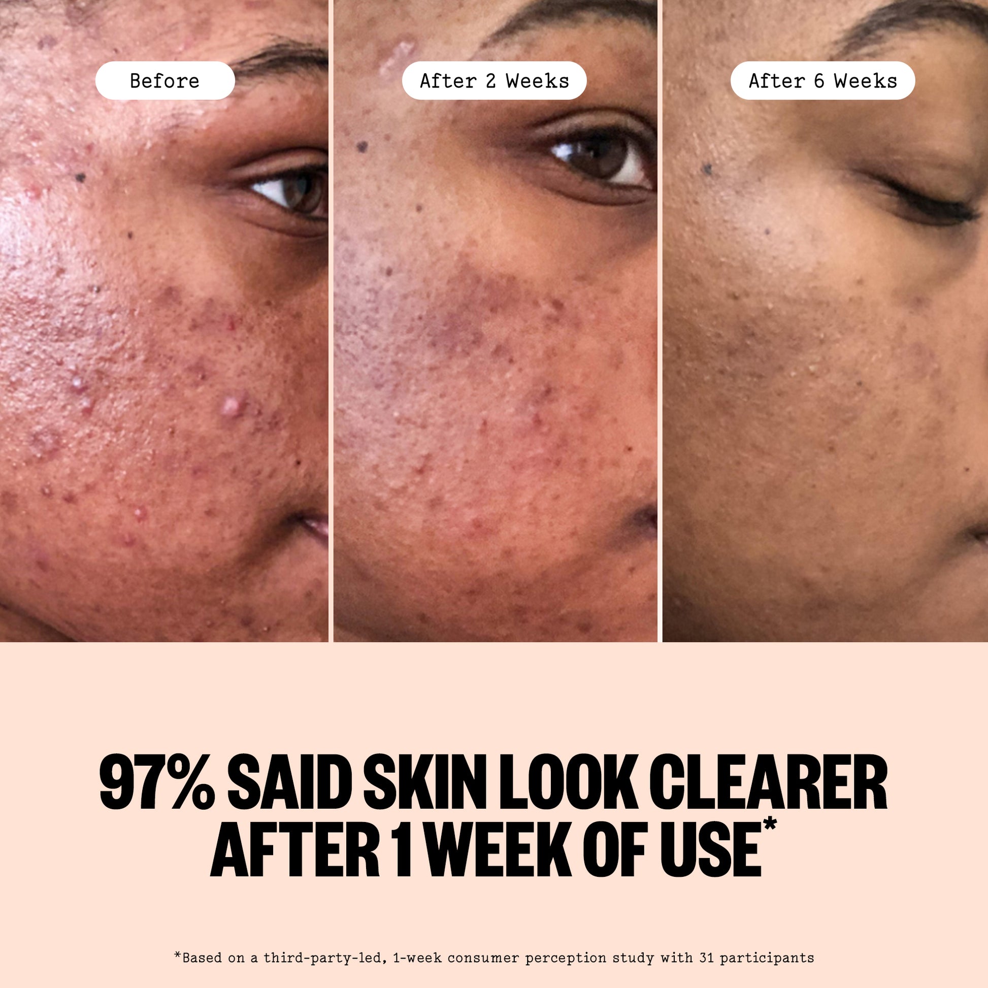 Before and after comparison of skin treatment through Peace Out Acne Serum showing improvement over time.