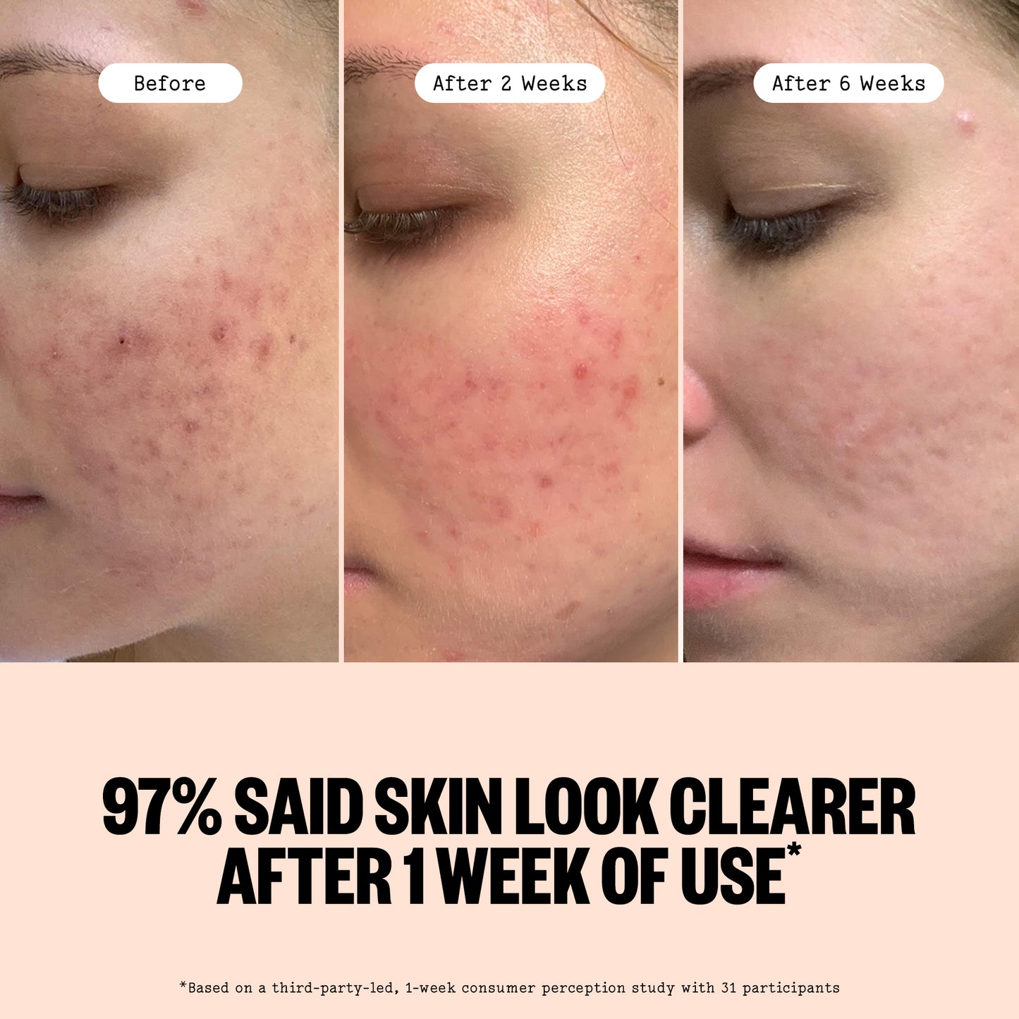 Before and after comparison of skin clarity with text indicating improvement over time through Peace Out Acne Serum