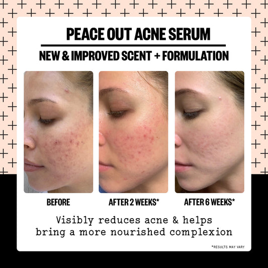Acne Serum (CAN)