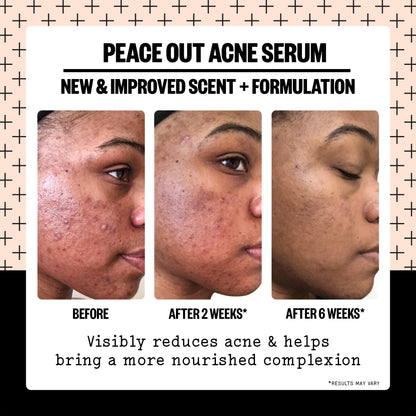 Acne Serum (CAN)