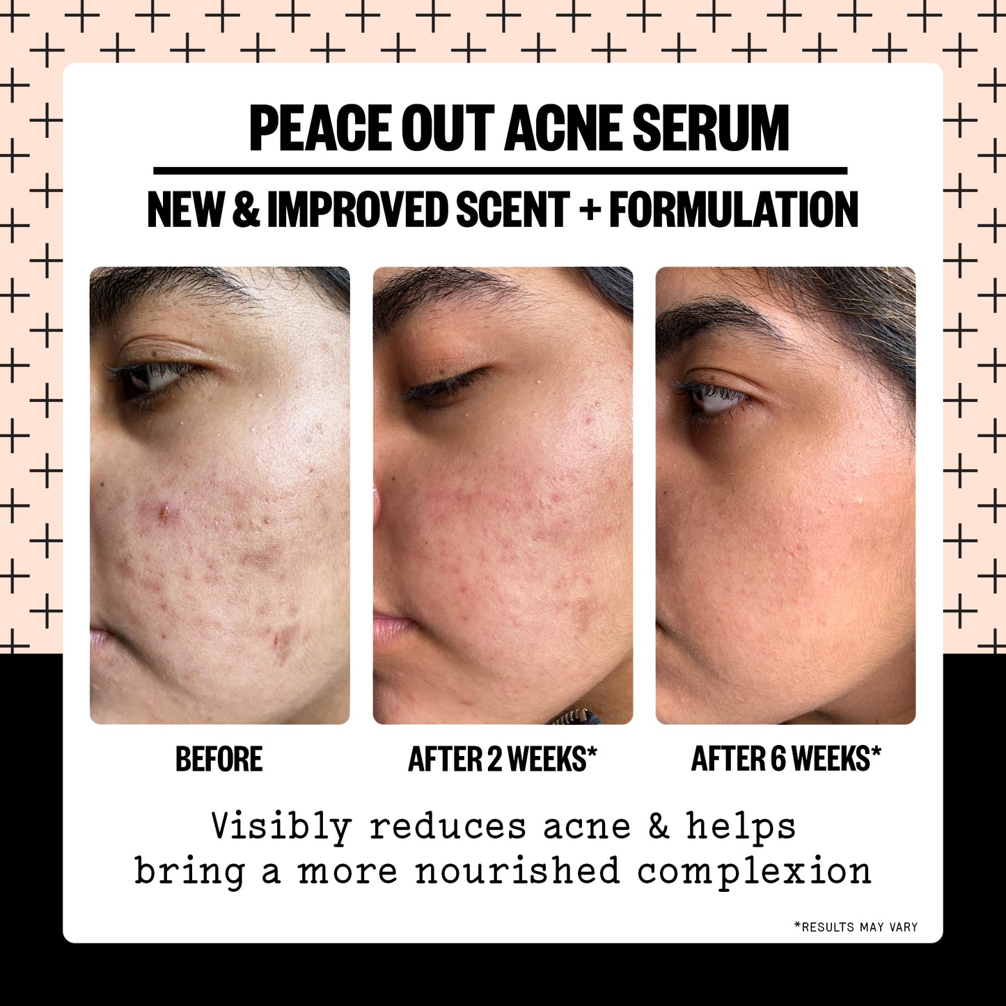 Acne Serum