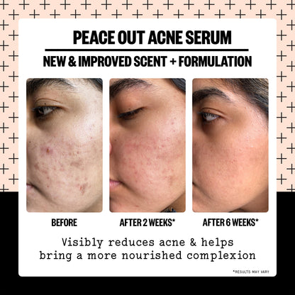 Acne Serum (CAN)