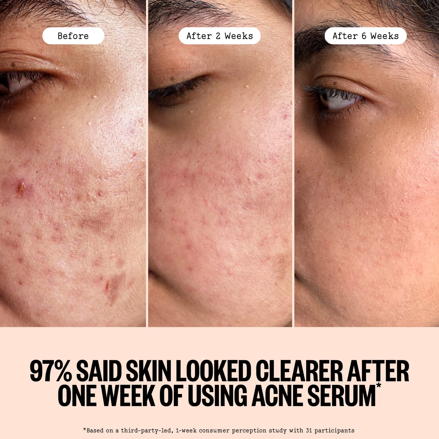 Three-panel close-up of a person's cheek showing acne improvement over time, labeled Before, After 2 Weeks, and After 6 Weeks, with text below stating 97% said skin looked clearer after one week of using Peace Out Acne Serum.