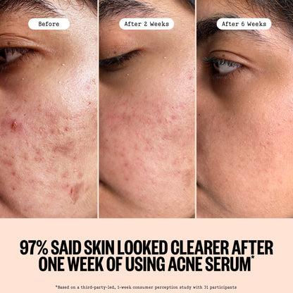 Peace Out Acne Serum before, 2 weeks and 6 weeks: 97% said skin looked clearer after one week.