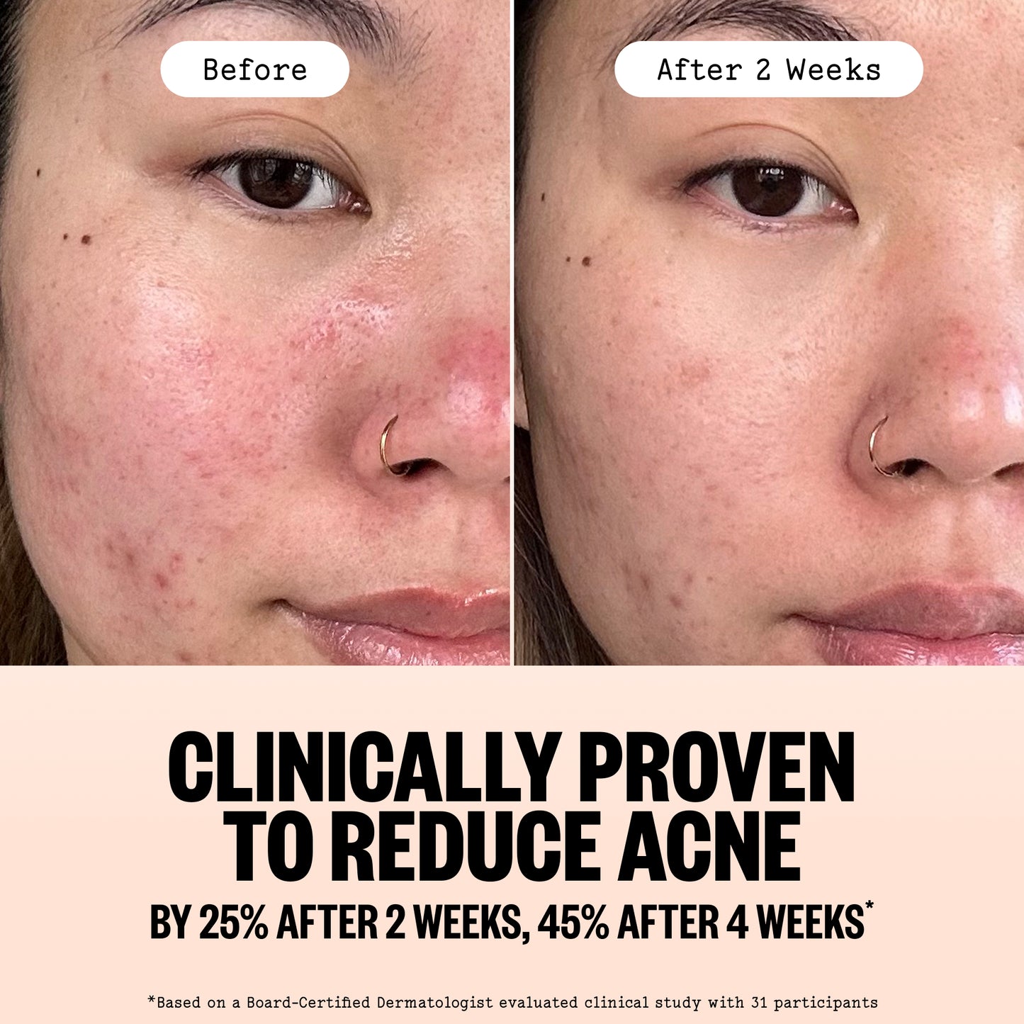 Before-and-after split comparison of a woman's face showing acne reduction over two weeks, with text below stating 'Clinically Proven to Reduce Acne by 25% After 2 Weeks, 45% After 4 Weeks'.