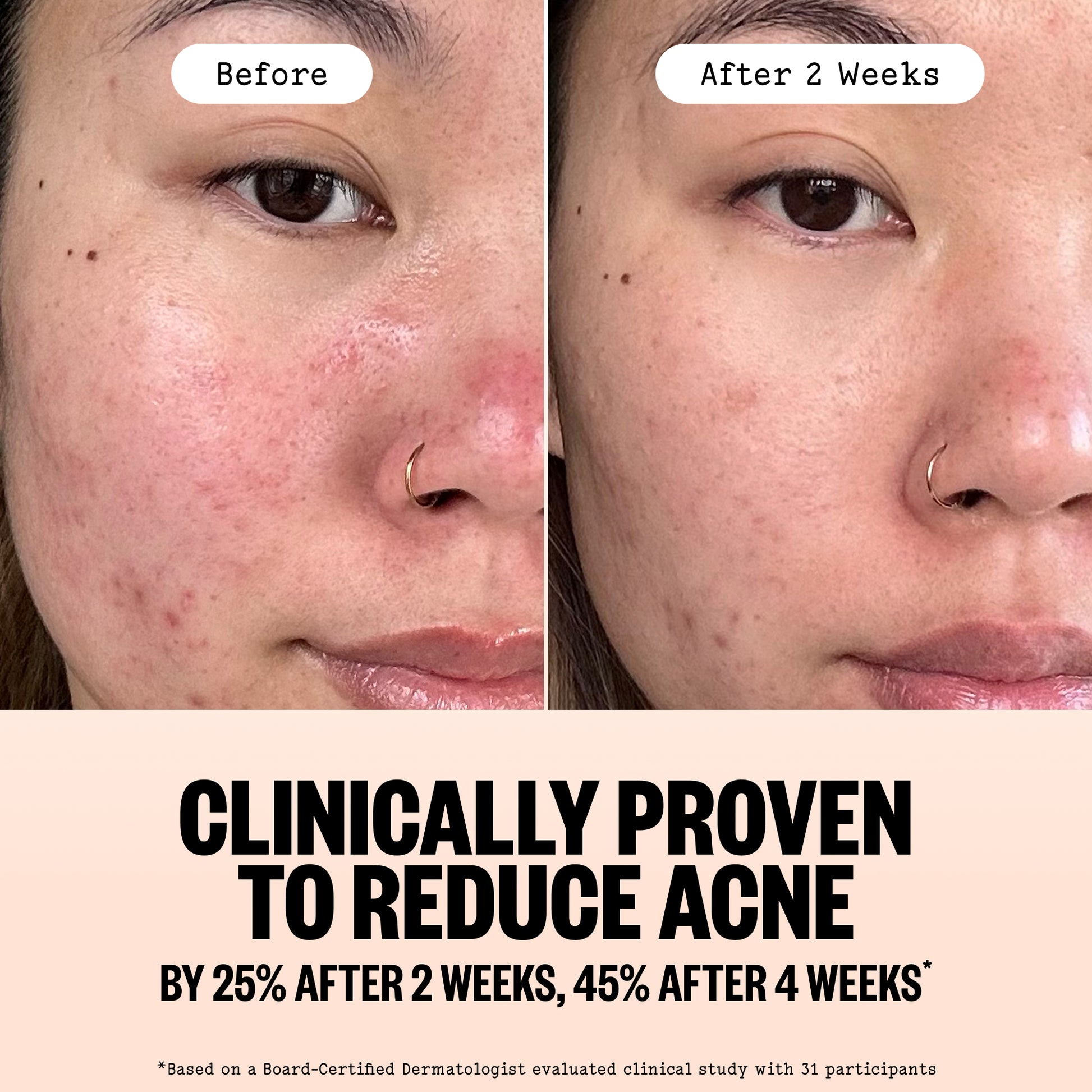 Before-and-after split comparison of a woman's face showing acne reduction over two weeks, with text below stating 'Clinically Proven to Reduce Acne by 25% After 2 Weeks, 45% After 4 Weeks'.
