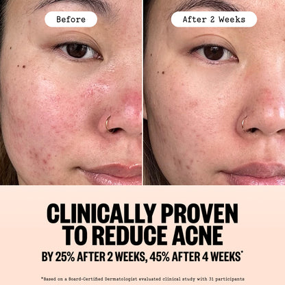 Before-and-after split comparison of a woman's face showing acne reduction over two weeks, with text below stating 'Clinically Proven to Reduce Acne by 25% After 2 Weeks, 45% After 4 Weeks'.