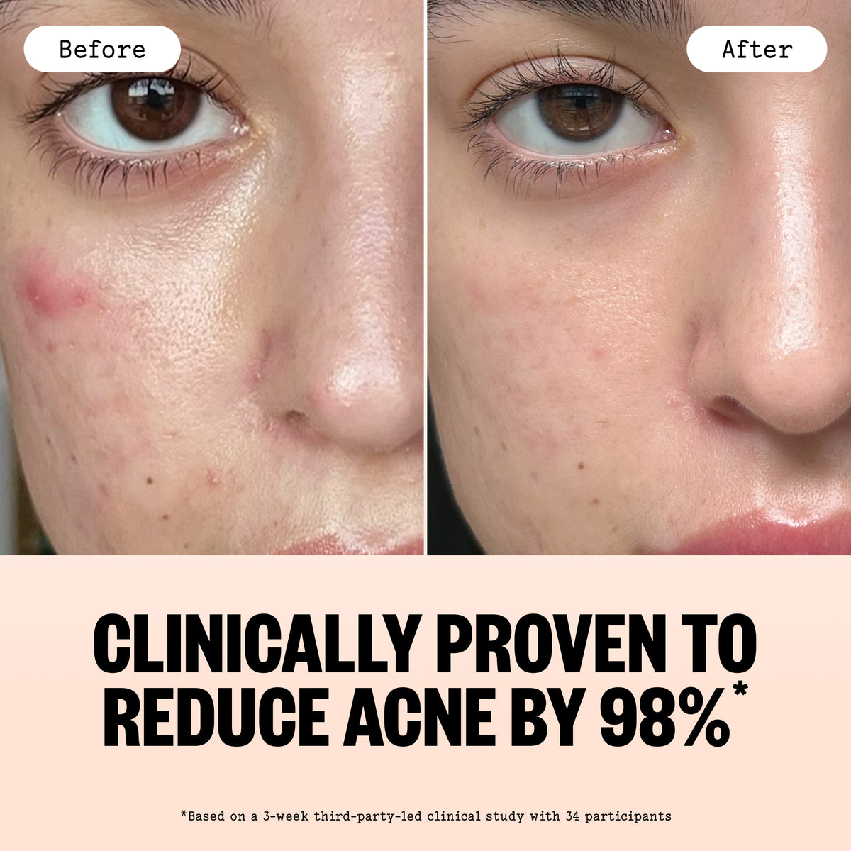 Before-and-after comparison of a person's cheek after using Acne Gel Moisturizer showing acne reduction, with text below reading 'CLINICALLY PROVEN TO REDUCE ACNE BY 98%'.