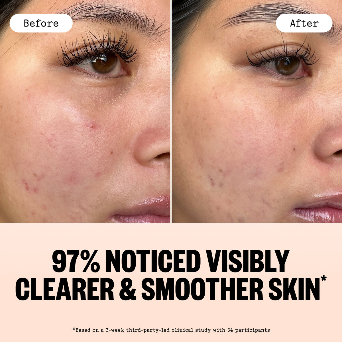 Before and after facial skin comparison on a woman's cheek after using Acne Gel Moisturizer, showing acne breakouts and clearer smoother skin, with text reading '97% NOTICED VISIBLY CLEARER & SMOOTHER SKIN' and a clinical study note below.